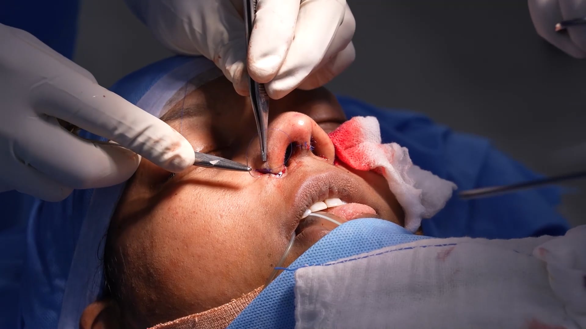 Rhinoplasty for sharp tip with alarplasty